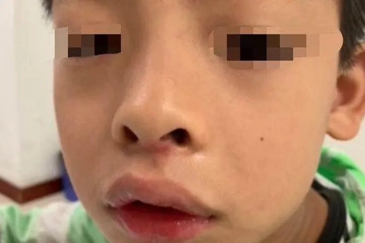 12岁腺样体面容图片