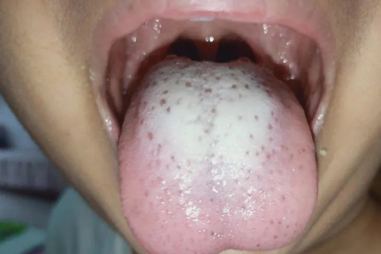 胃癌的舌头早期症状图片