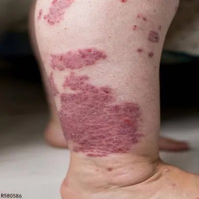 治疗银屑病的中药有哪些 这几个中药方可改善银屑病