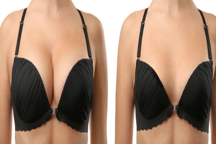 做隆胸手术效果图片