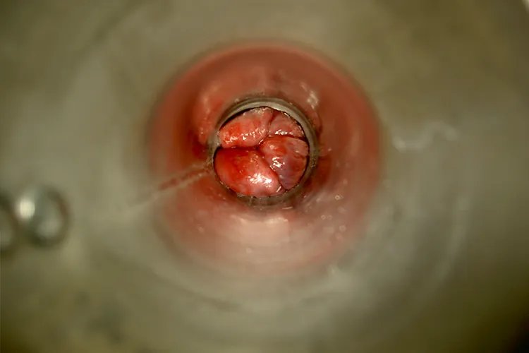 痔疮轻度与重度的图片