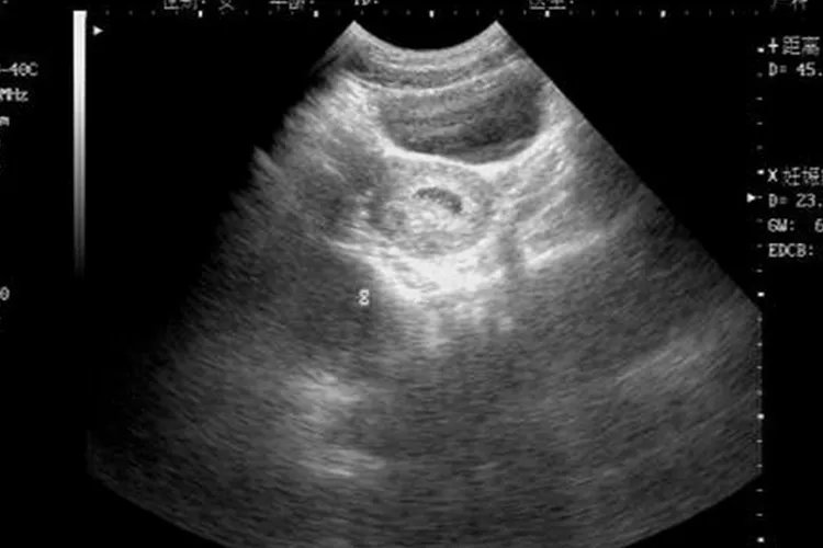 怀孕5周胎儿真实图片