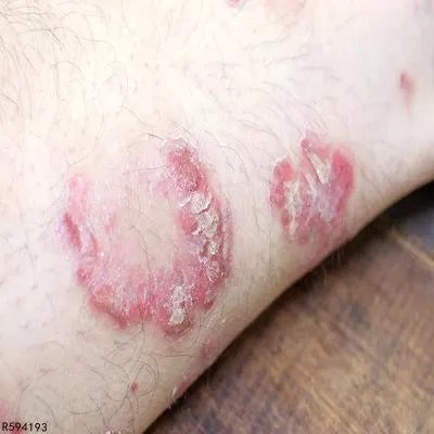 肌肉萎缩性侧索硬化症是怎么引起的