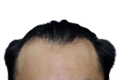 鬓角掉发是什么原因