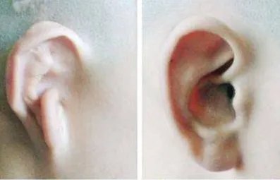 耳垂整形的适应症有哪些