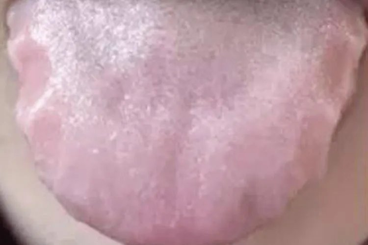 胃癌的舌头早期症状图片