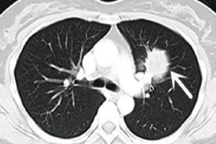 男性感染霉菌的症状是什么样子的