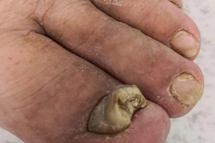 灰指甲由轻到重的图片