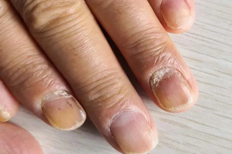 灰指甲由轻到重的图片