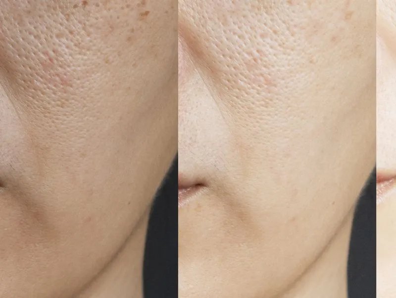 脸上法令纹怎么去除