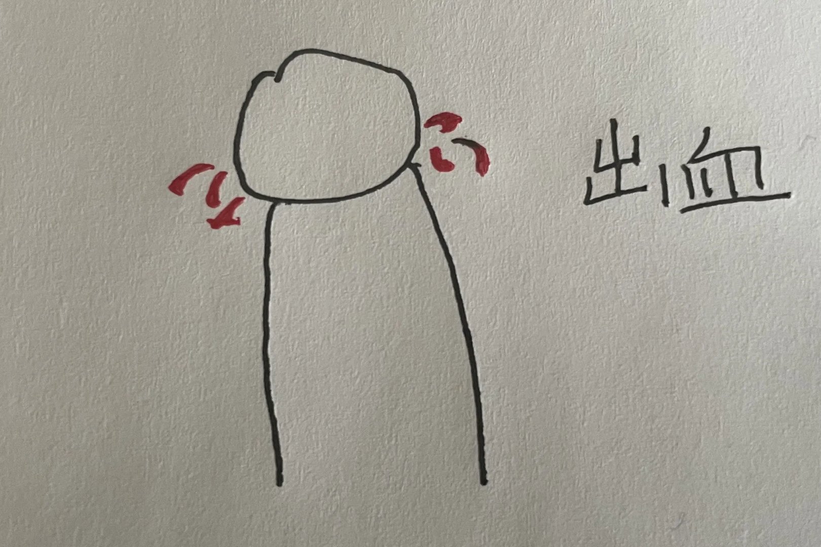 包皮环切手术术后水肿图片