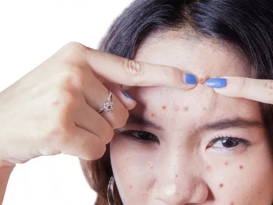 祛痘常识