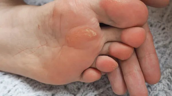 脚上长鸡眼怎么办