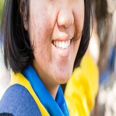 脸上长了好多红痘痘该怎么消除