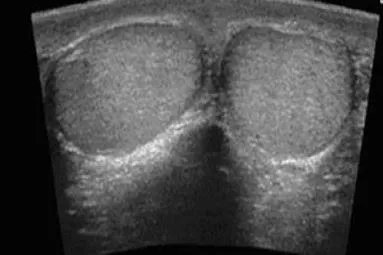 正常婴儿的蛋蛋的图片