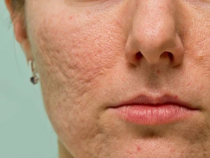 白头痤疮是怎么形成的