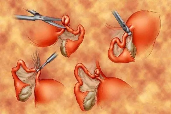 结扎用线扎的图片