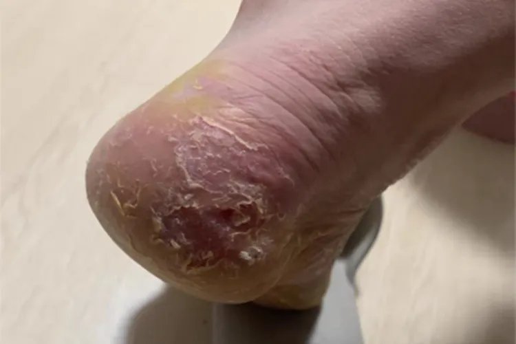 鳞屑角化型足癣皮肤粗糙图片