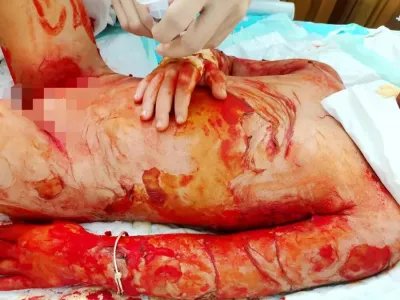 葡萄球菌性烫伤样皮肤综合征糜烂图片