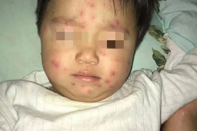 孩子水痘图片初期图片