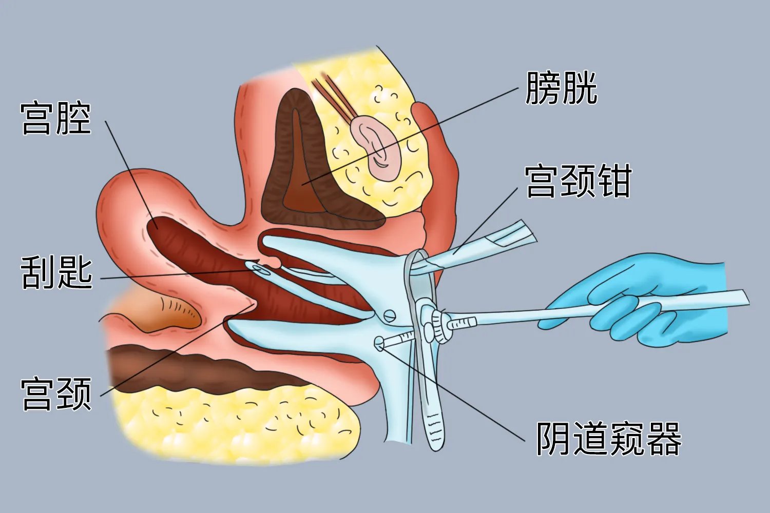 刮宫手术怎么做图解