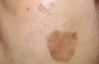 如何祛男性黄褐斑