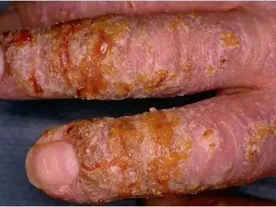 葡萄球菌性烫伤样皮肤综合征糜烂图片