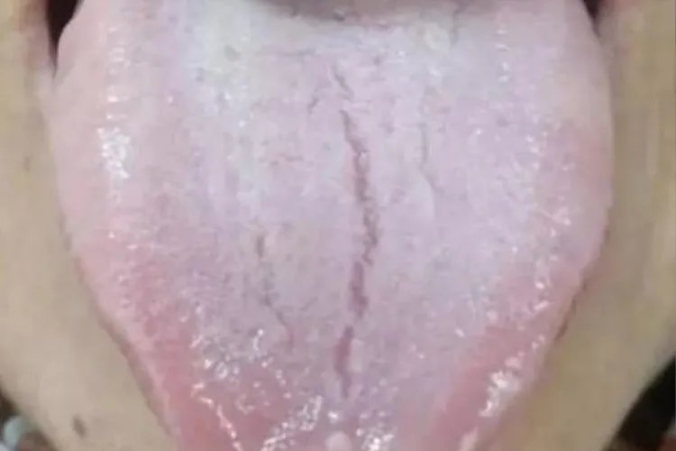 胃癌的舌头早期症状图片