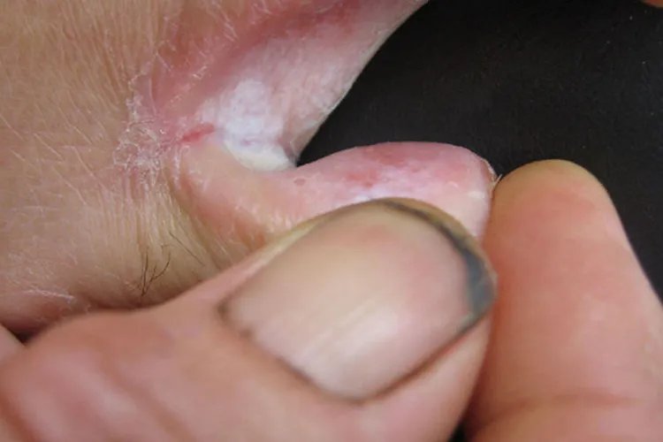 各种皮癣的图片大全