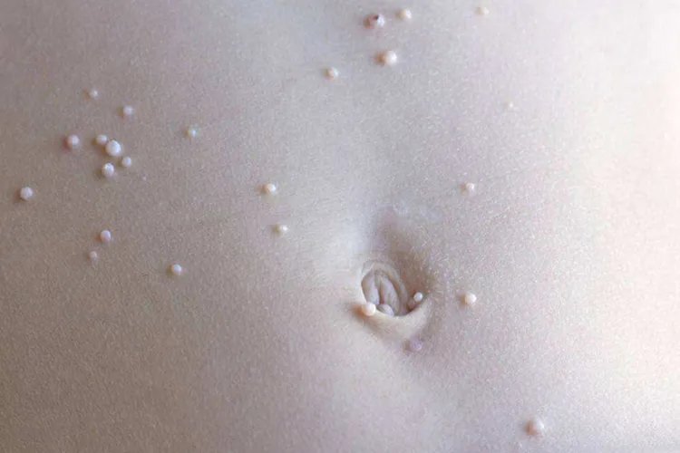 小孩身上长水瘊子图片