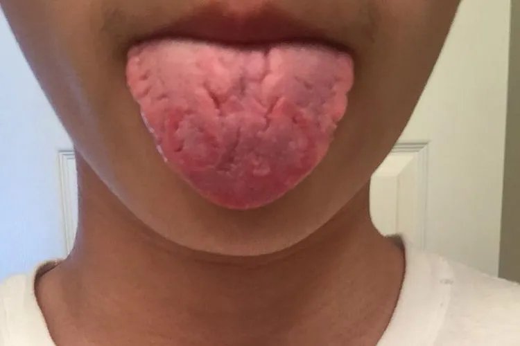 胃癌的舌头早期症状图片