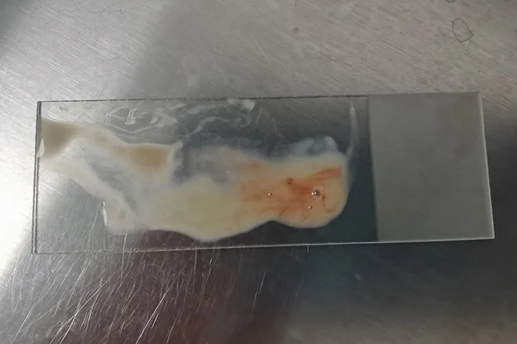 宫颈癌出血的颜色及量图片