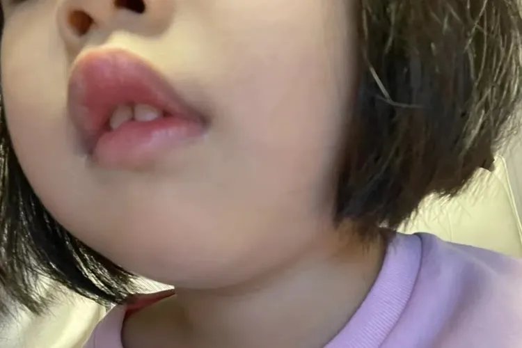 腺样体肥大的小孩面容图片