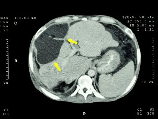 肿瘤生物治疗的效果