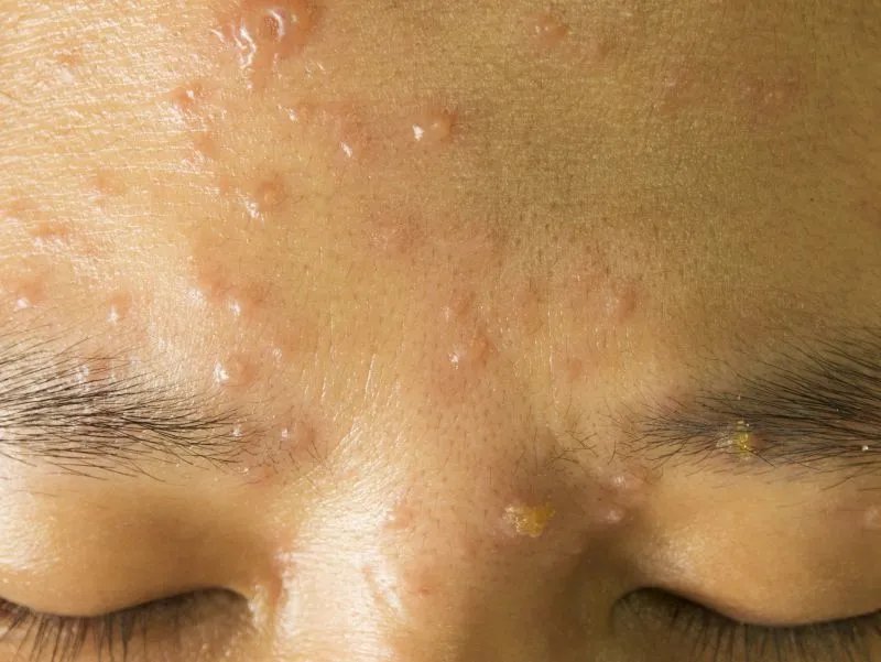 额头上长硬疙瘩怎么办