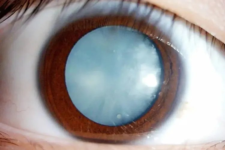 白内障分期分为四期图片