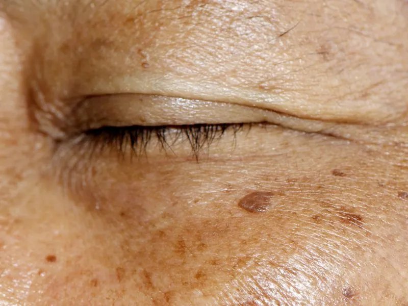 彩光祛斑的效果