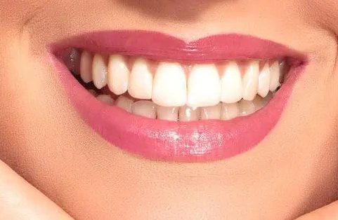 一颗牙齿做牙套多少钱