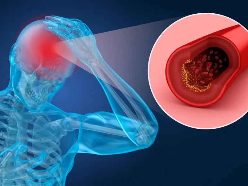 脑溢血后遗症的治疗