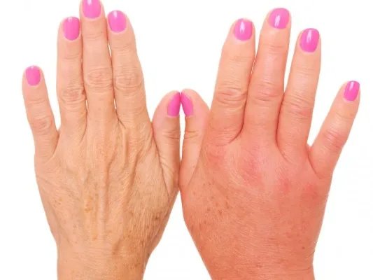 手部如何去角质