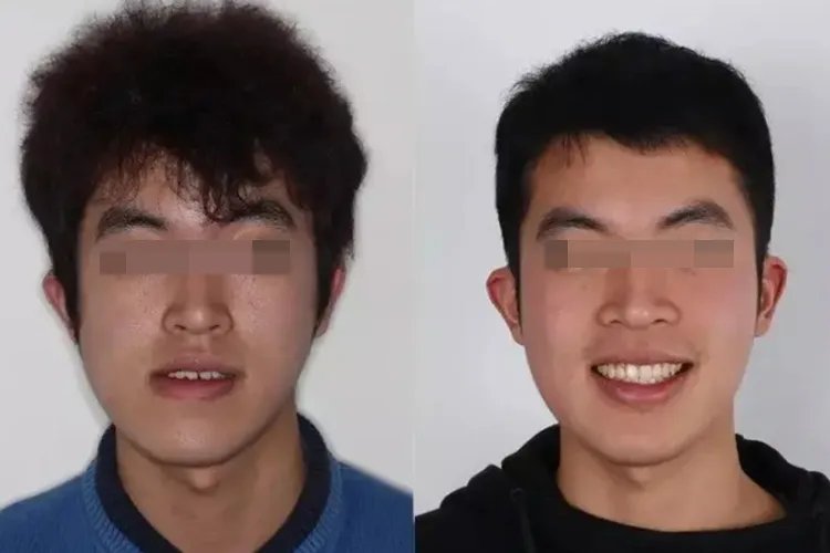 脸歪严重矫正图片