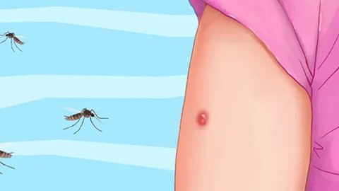 臭虫咬的症状是什么样子