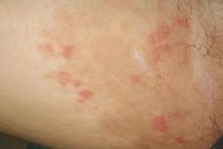 睾丸旁边大腿内侧红斑图片