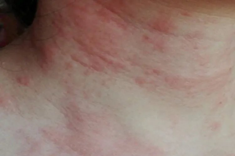 脖子皮肤过敏图片