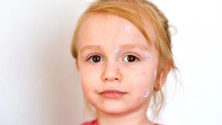 激光治疗黄褐斑有没有副作用