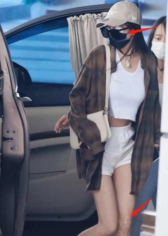 杨幂受伤后首次现身，戴着墨镜用纱布缠着眼角，她的状态如何？