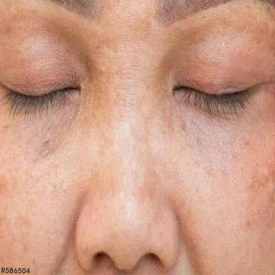 鸡蛋能祛斑淡化斑点吗