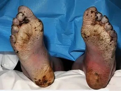 浸渍足脚底皮肤粗糙图片