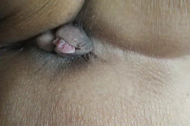 什么是痔疮图片