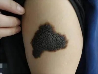 恶性雀斑样痣黑斑图片